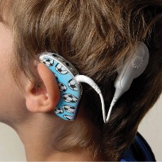 Cochlear Implants