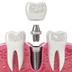 Dental Implants