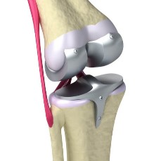 Knee Implants