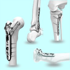 Orthopedic Implants